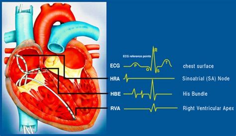 electrophysiology arrhythmia near occidental|The Future of Arrhythmias and Electrophysiology .